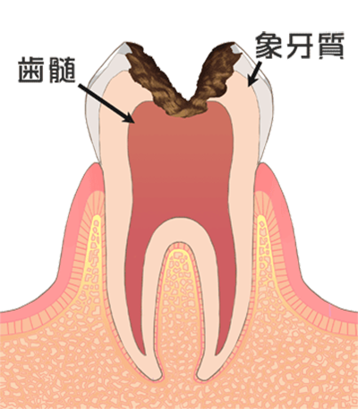 ④虫歯が神経まで進み、とても危険な状態です