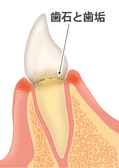 ②歯垢（プラーク）がたまった状態を放置していくと、歯肉に炎症が起き、隙間が徐々に開いていきます