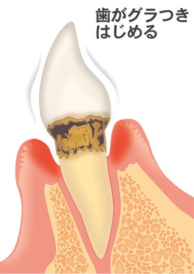 ④炎症がさらに拡大し、悪化すると歯槽骨も半分近くまで溶け始め、歯がどんどんグラグラしていきます